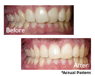 Closeup of smile before and Invisalign