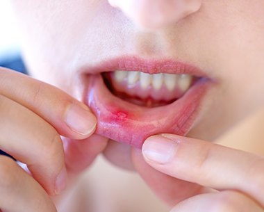 Patient with sore on lip before laser canker sore and ulcer treatment