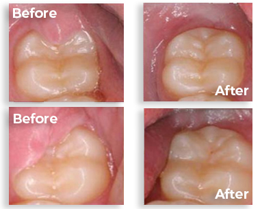Tooth before and after laser operculectomy
