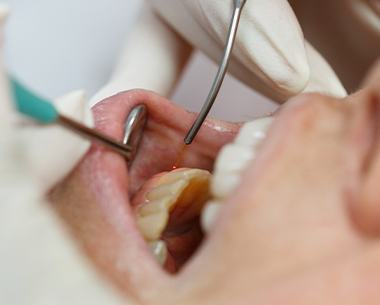 Closeup of patient receiving painless laser dentistry