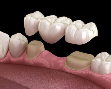 Illustration of traditional dental bridge being placed on teeth?
