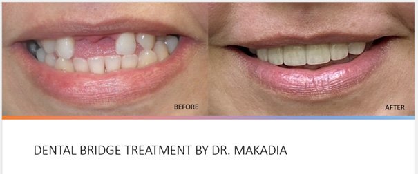 dental bridge treatment by Dr. Makandia