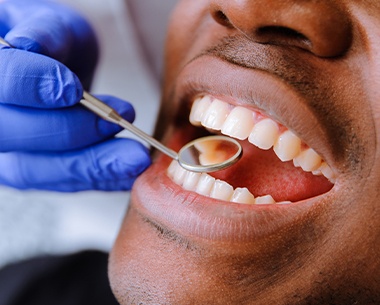 Dentist examining patient's smile after tooth colored filling restoration