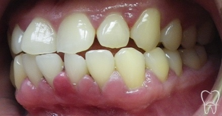 Smile with red swollen and bleeding gums