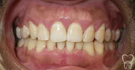 Smile after laser gum treatment to reattach teeth and improve oral health