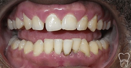 Smile with loose teeth due to detached gums