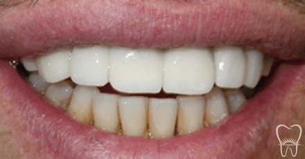 Aligned and healthy smile after orthodontics and restorative dentistry
