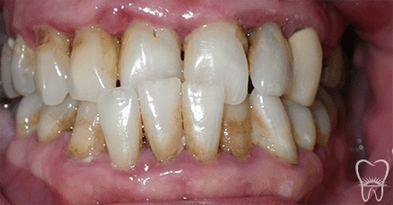 Misaligned and decayed teeth