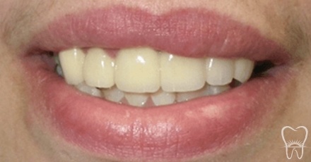 Patient's smile after flawless fixed bridge placement