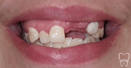 Smile with missing teeth and dental damage