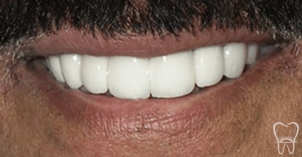 Healthy flawless smile after dental crown and fixed bridge restorations