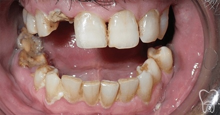 Severely damaged and decayed smile with several missing teeth