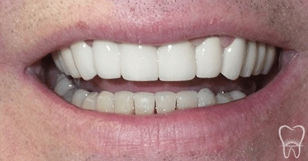 Closeup of flawless smile after smile makeover