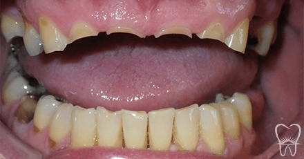 Severely worn teeth and collapsed bite