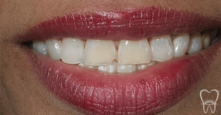 Closeup of smile with yellow stained teeth and failing dental bridge