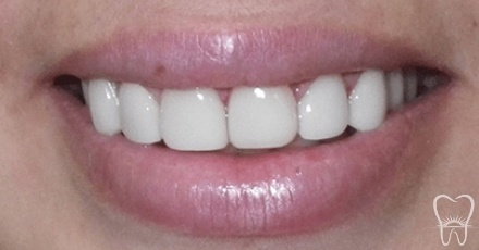 Closeup of bright healthy smile after smile makeover