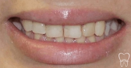 Closeup of darkly discolred and crooked teeth