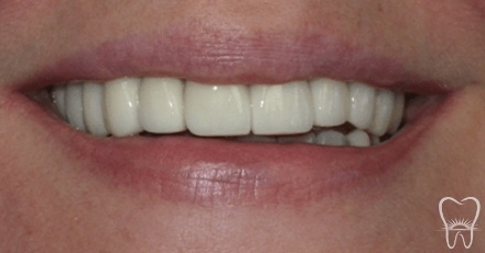 Closeup of perfected smile after dental restoration and tooth replacement