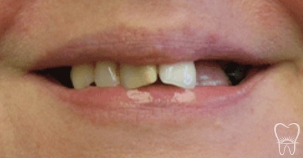 Closeup of smile with damaged and missing teeth