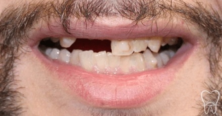 Man with several missing teeth before his wedding