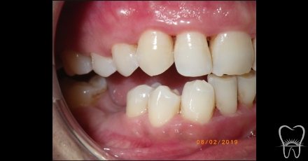 Smile after laser gum therapy