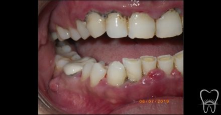 Patient with smile damaged due to advanced gum disease