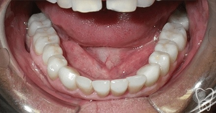 Flawless smile after dental crowns and dental bonding