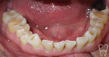 Smile with severely worn bottom teeth