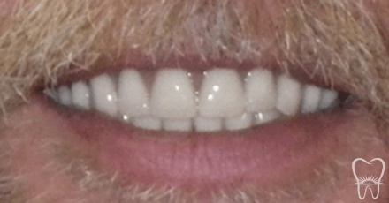 Flawless smile after replacing lost bottom teeth