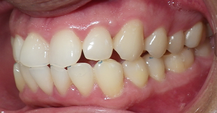 Helathy teeth and gums after laser gum disease treatment and restorative dentistry