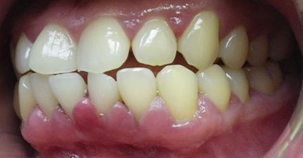 Smile with red swollen and bleeding gums