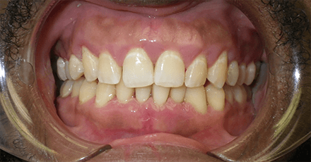 Smile after laser gum treatment to reattach teeth and improve oral health