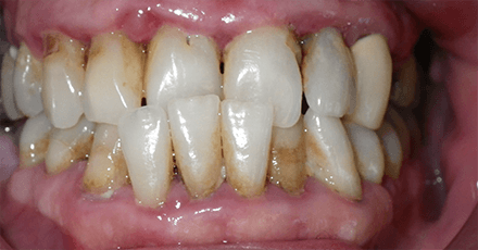 Misaligned and decayed teeth