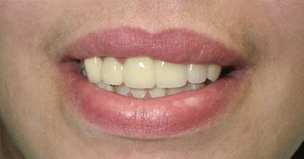 Patient's smile after flawless fixed bridge placement