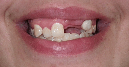Smile with missing teeth and dental damage