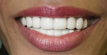 Closeup of perfected smile after porcelain veneers and dental bridge restoration