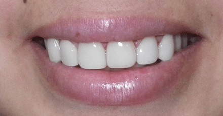 Closeup of bright healthy smile after smile makeover