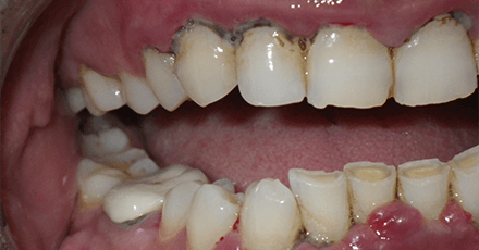 Patient with smile damaged due to advanced gum disease