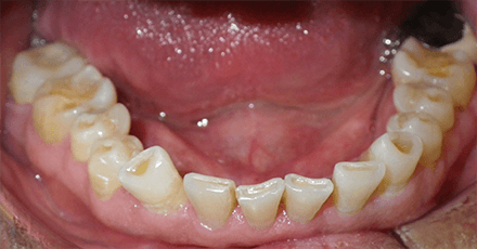 Smile with severely worn bottom teeth