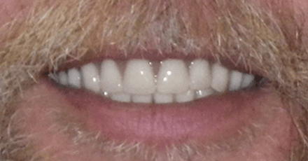 Flawless smile after replacing lost bottom teeth