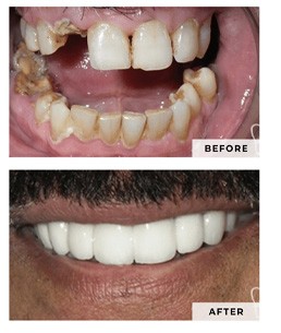 Crown Treatment by Dr. Makadia- Actual patient   