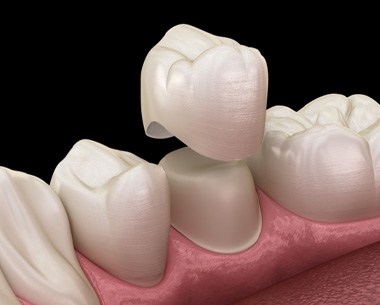 Illustration of dental crown being placed on prepared tooth  