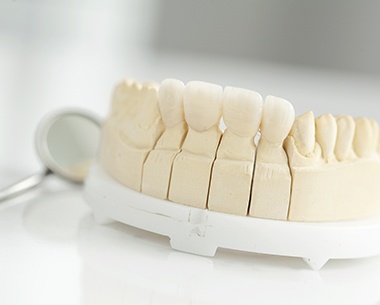 Model smile with dental bridge restoration