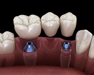 Animated smile during dental implant supported fixed bridge placement