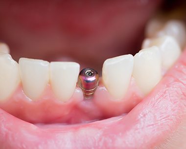 Dental implant visible in smile line after dental implant release