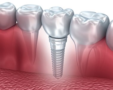 Animated smile with dental implant supported replacement tooth in need of treatment for peri-implantitis