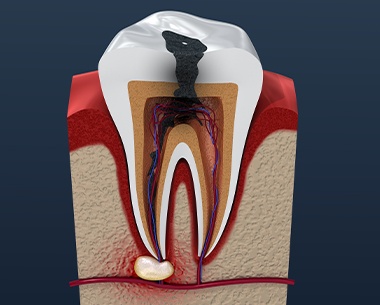 Animated tooth with decay before root canal therapy