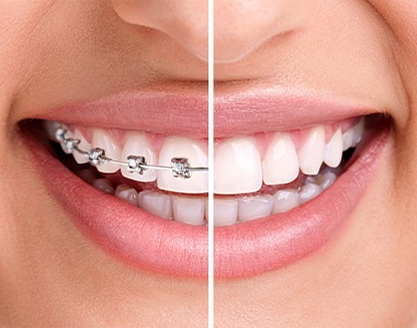 Smile before and after orthodontic bracket removal
