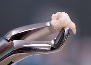 Metal clasp holding an extracted tooth