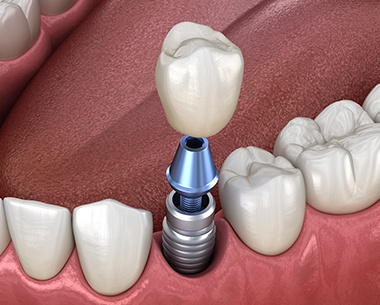 Animated smile during dental implant supported dental crown placement